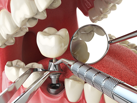 Tooth Implants Procedure at Brentwood Family Dental
