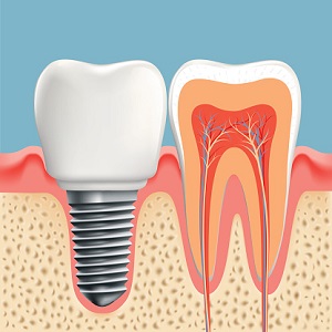 dental surgical implant at Brentwood Family Dental