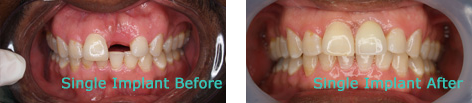 Dental Implants Brentwood CA - Dental Implants before and after the treatment 1