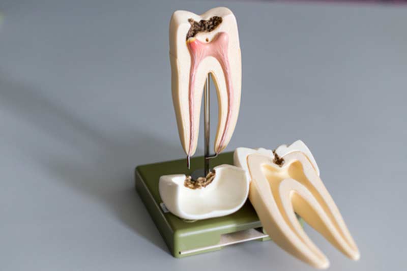 How Does Root Canal Prevent Tooth Loss in Brentwood, CA area