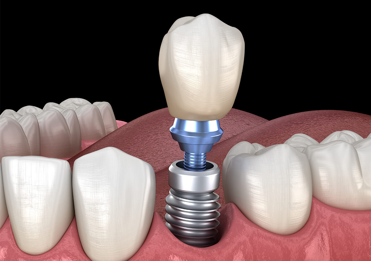 Implant Dentist in Brentwood CA Area