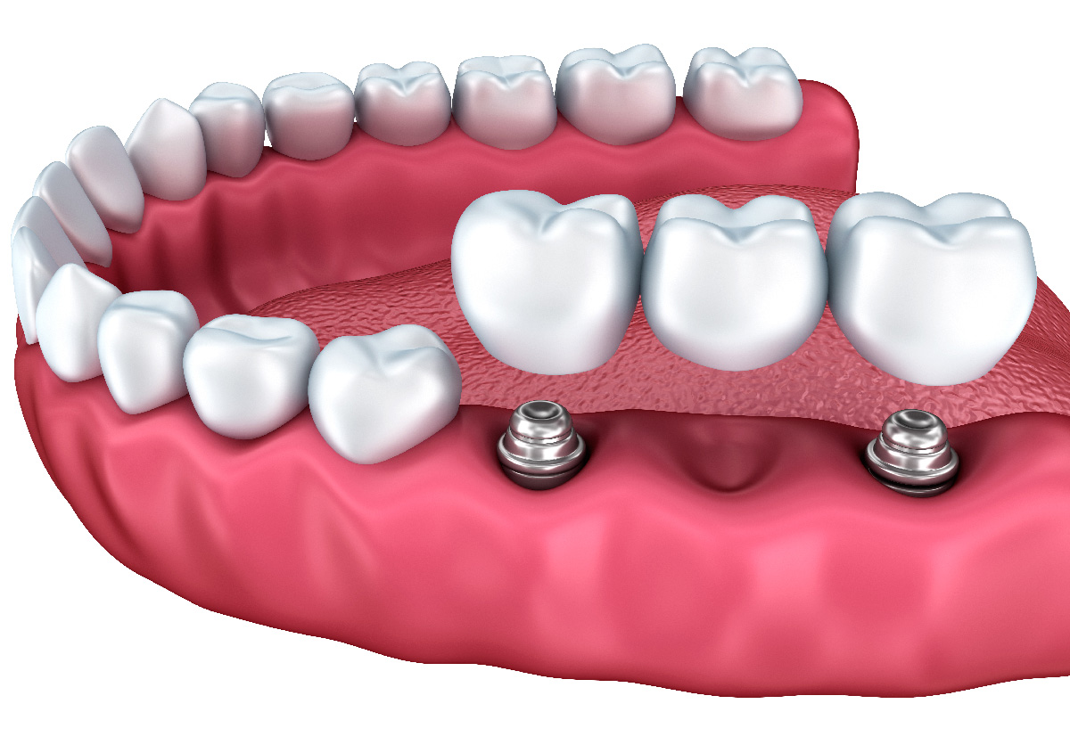What is the Process of Tooth Implant, Brentwood CA